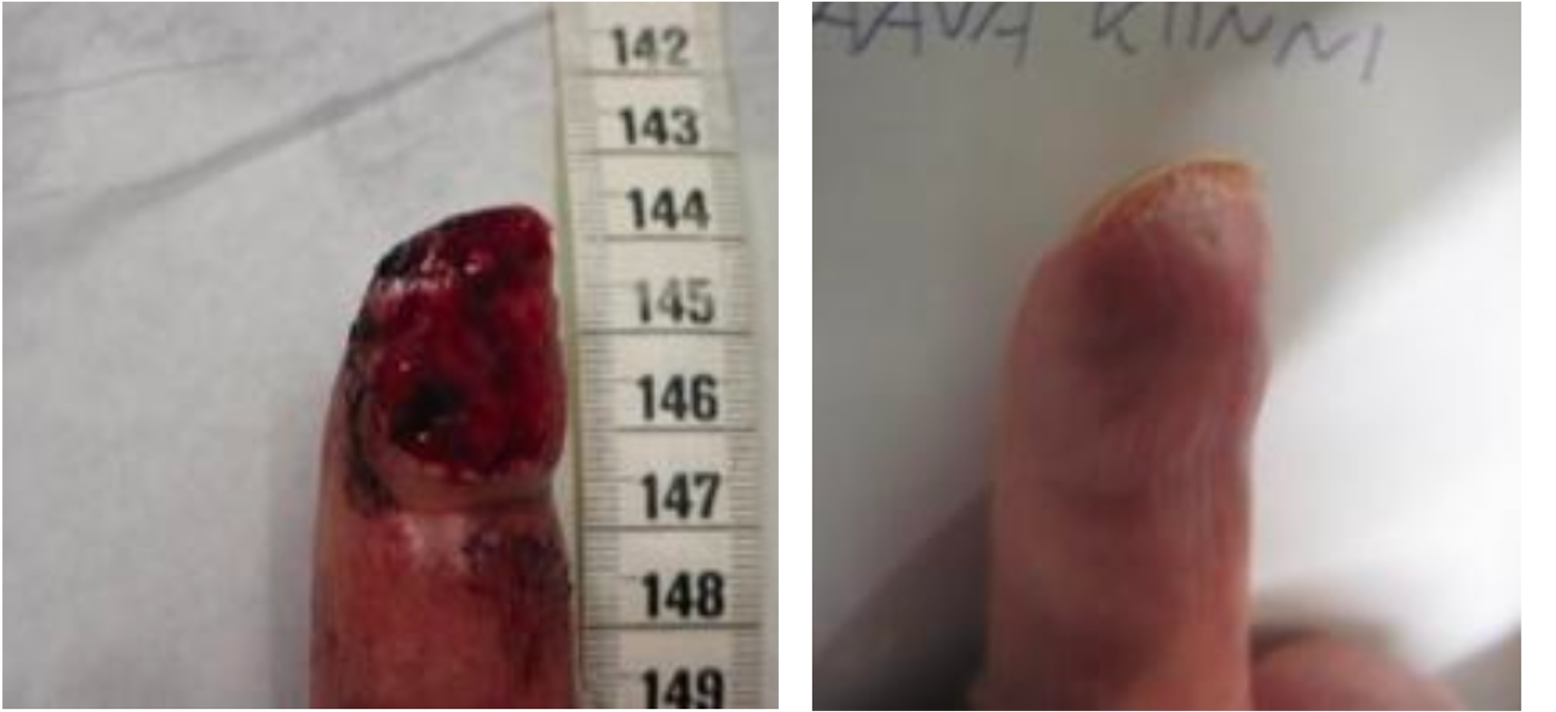 Day 1: Severe abrasion on the fingertip with exposed tissue. Day 65: Fully healed fingertip with restored skin integrity and minimal residual scarring.